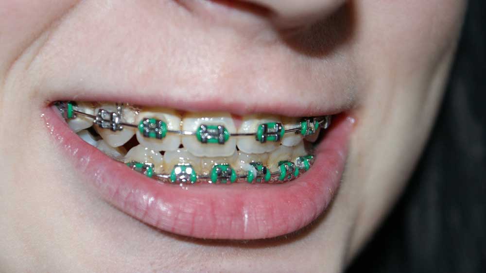 Gerade Zähne ohne Spange - Geht es auch ohne Zahnspange?