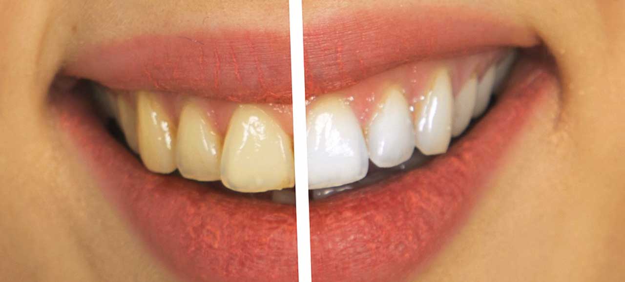 Zähne bleichen - professionelles oder Drogerie-Bleaching?