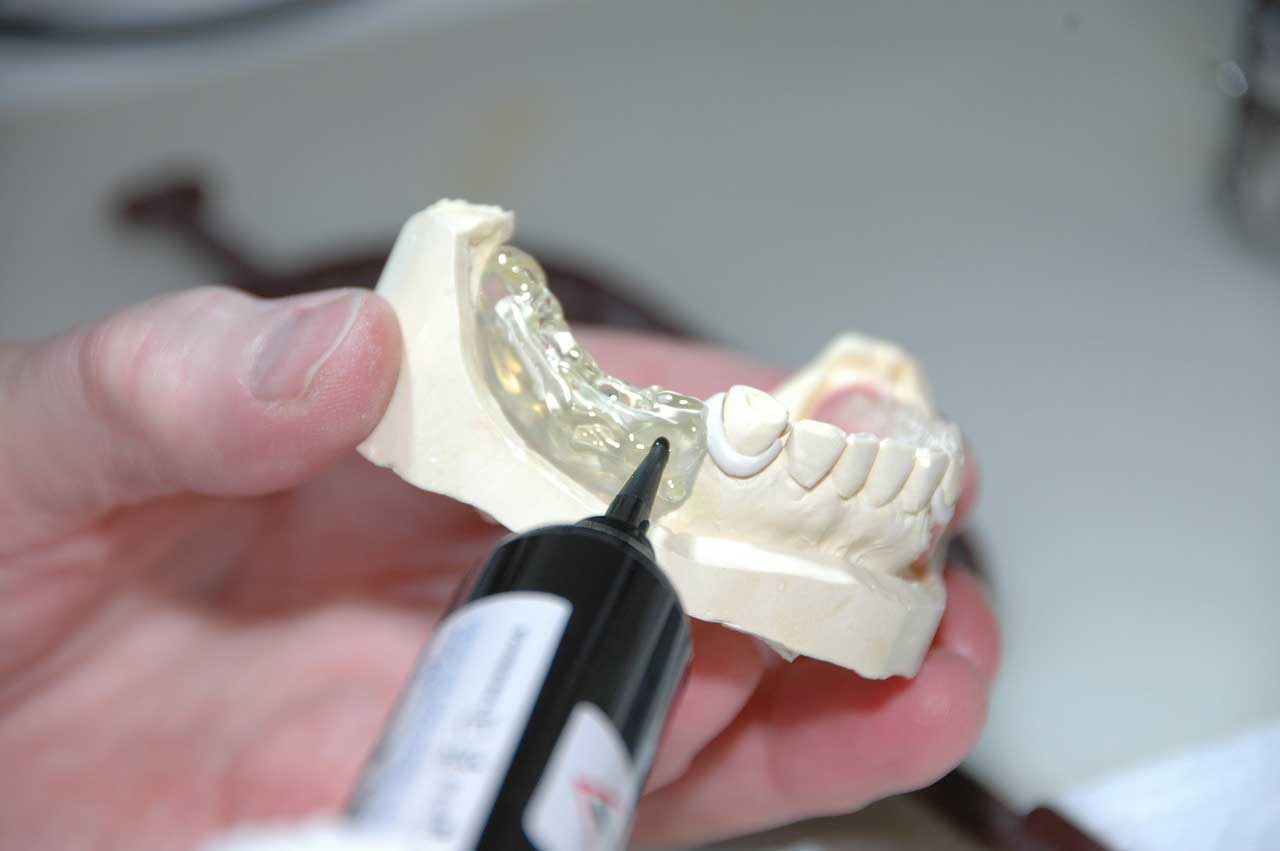 Provisorischer Zahnersatz - Was versteht man darunter?